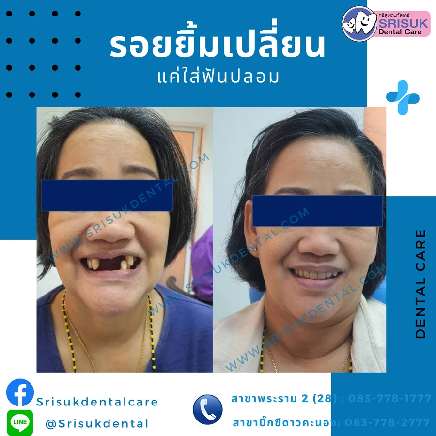 ฟันปลอม 5