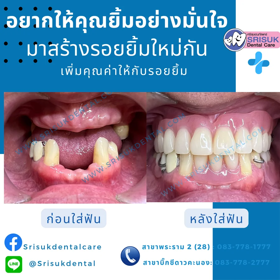 ฟันปลอม 7