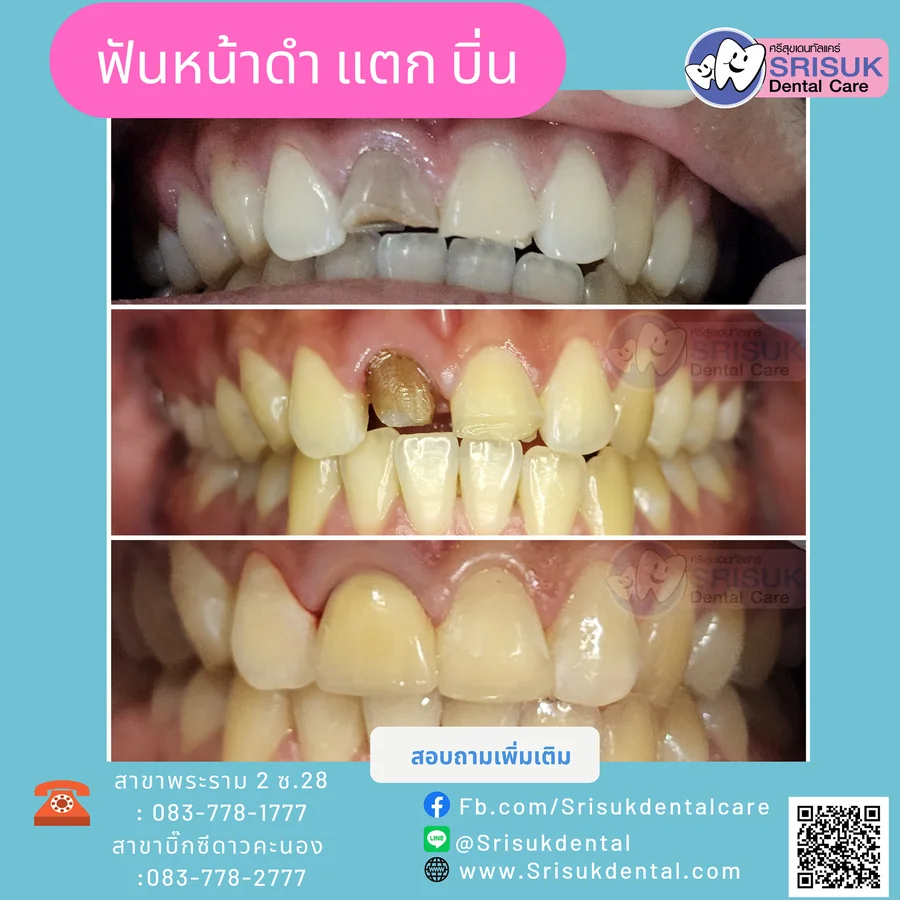 ฟันปลอม 11