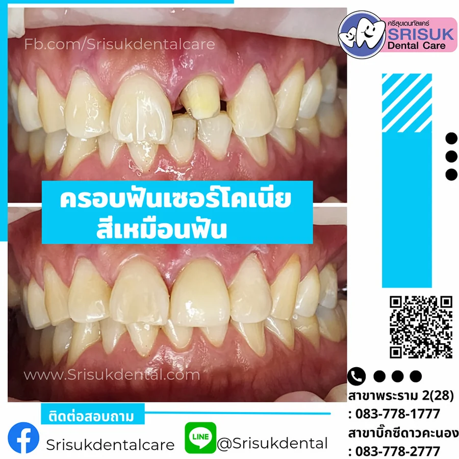 ฟันปลอม 12