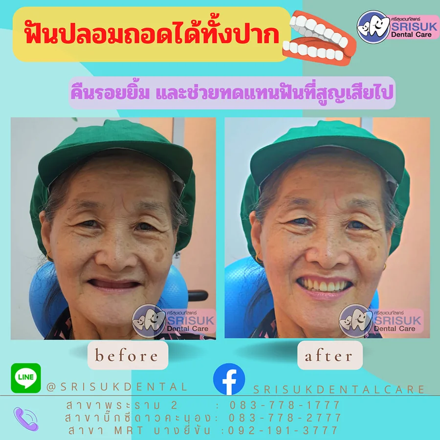 ฟันปลอม 15