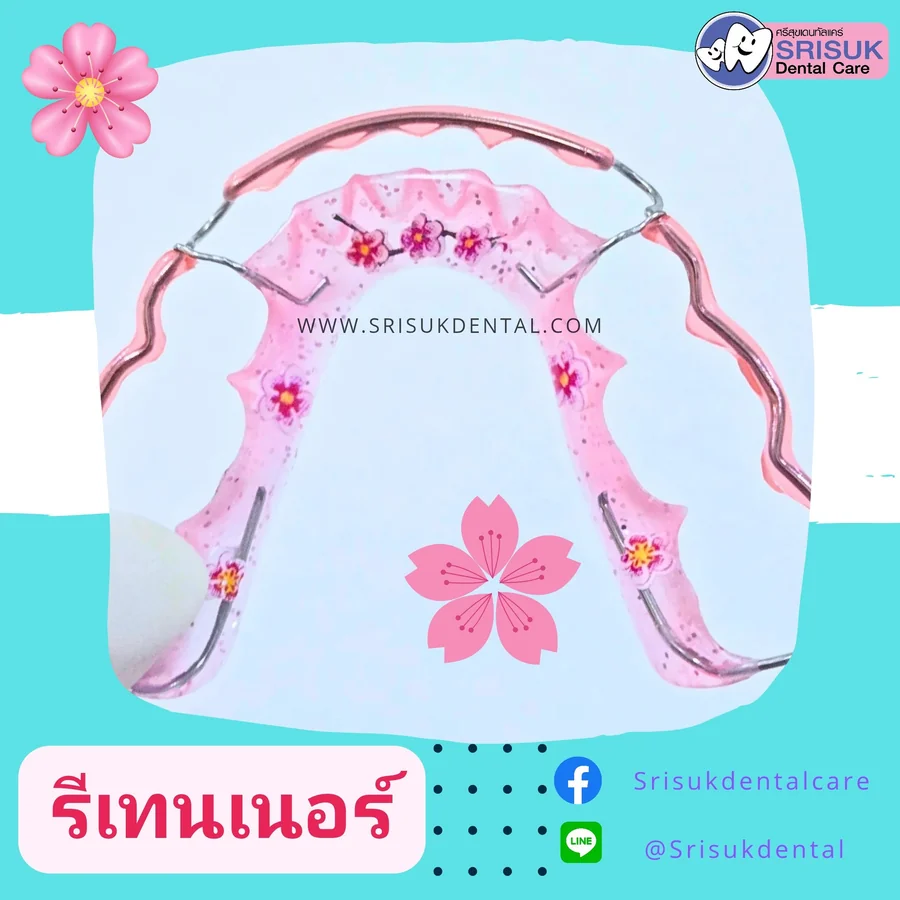 รีเทนเนอร์ 1