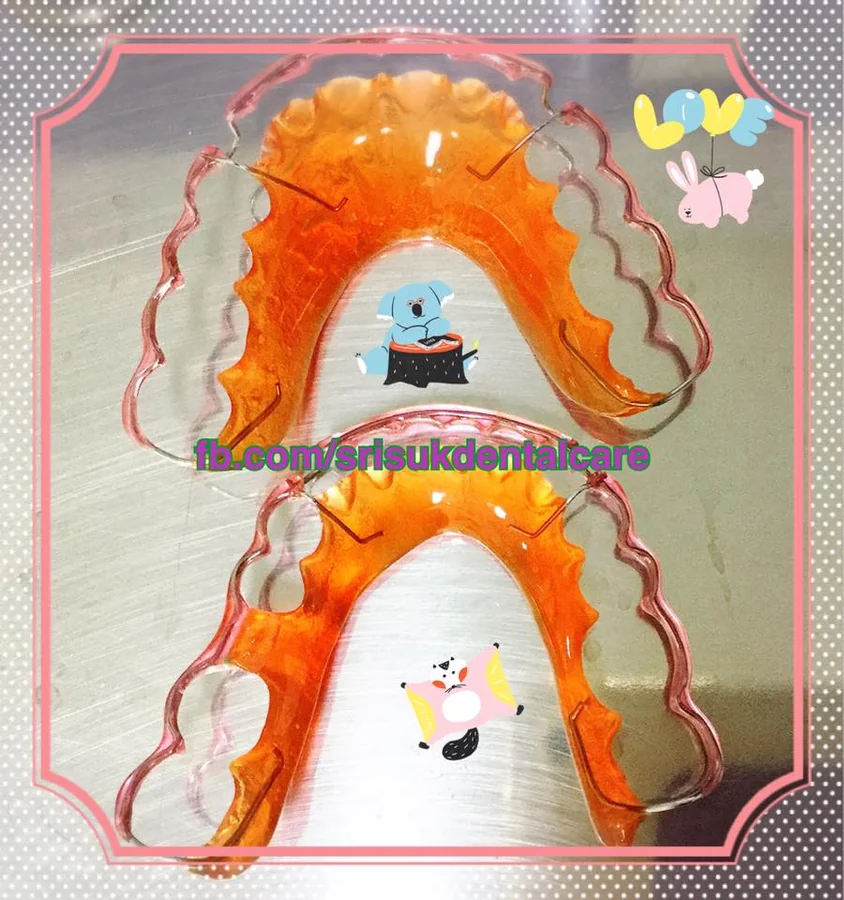 รีเทนเนอร์ 15