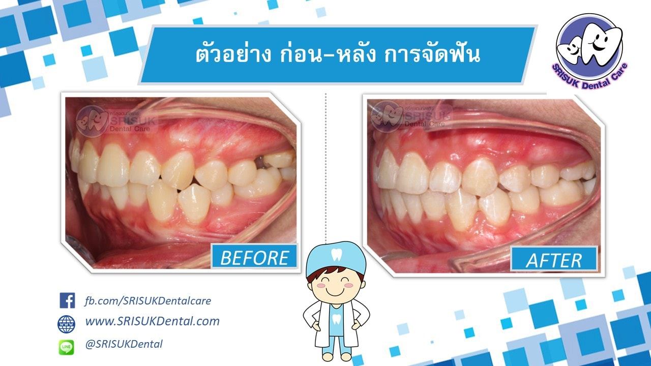 เคสจัดฟัน ก่อน-หลัง