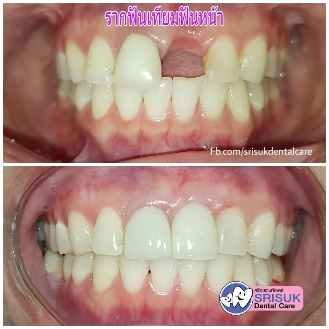 คืนช่องว่างฟันหน้าด้วยรากเทียม