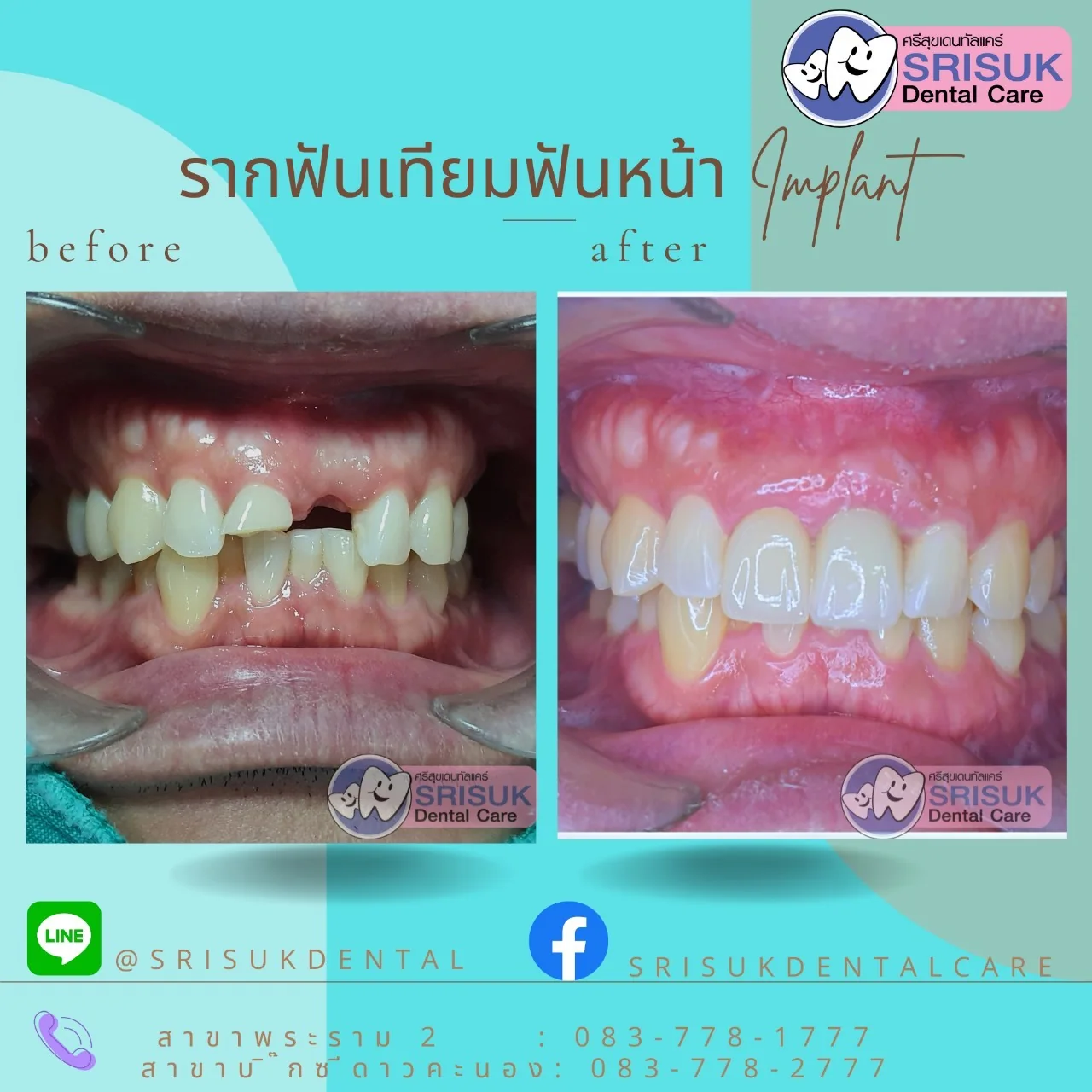 สัดส่วนฟันหน้าหลังบูรณะ
