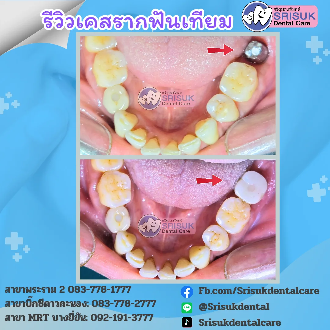 ตำแหน่งรากเทียมในแนวขากรรไกร