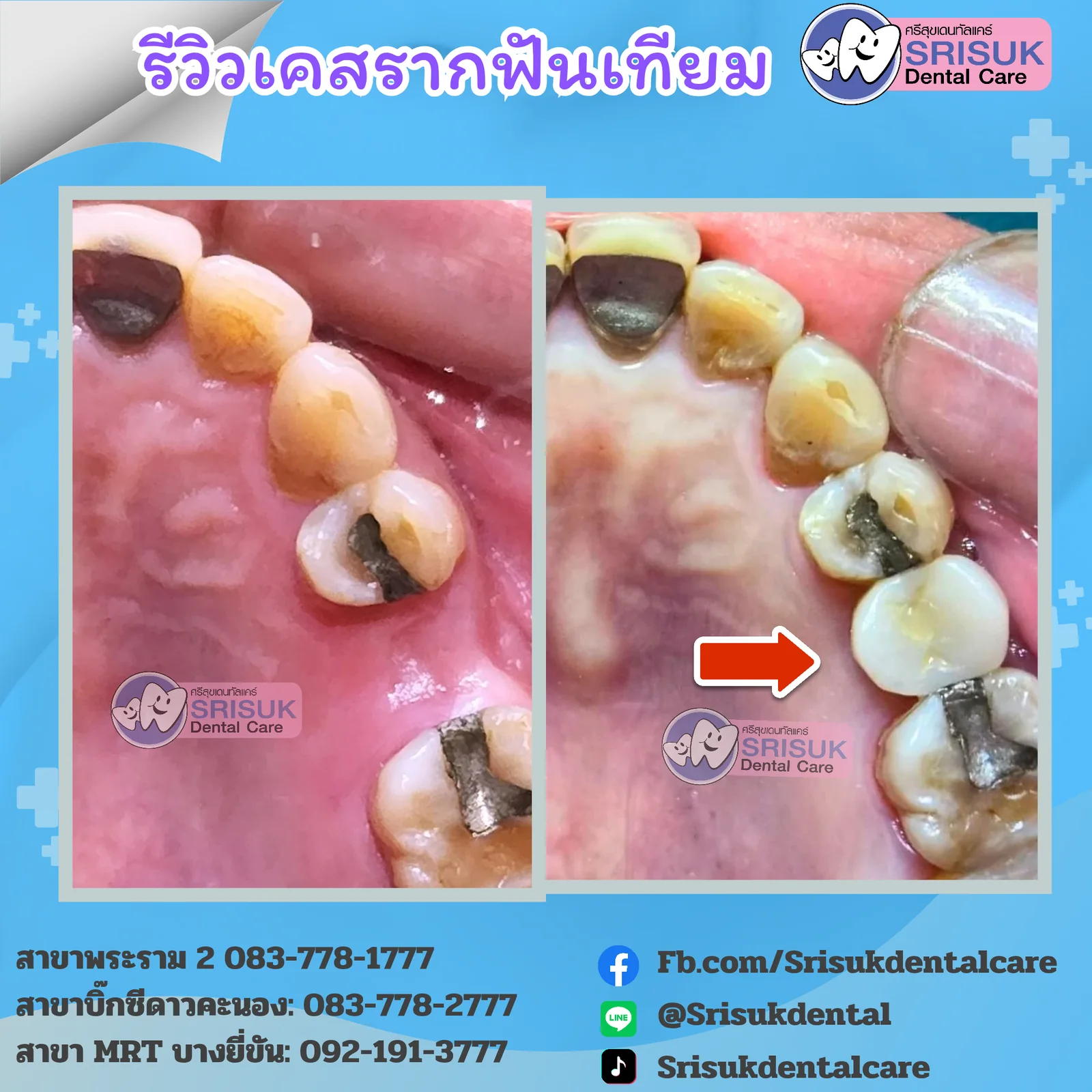 ทดแทนฟันกรามที่สูญเสีย