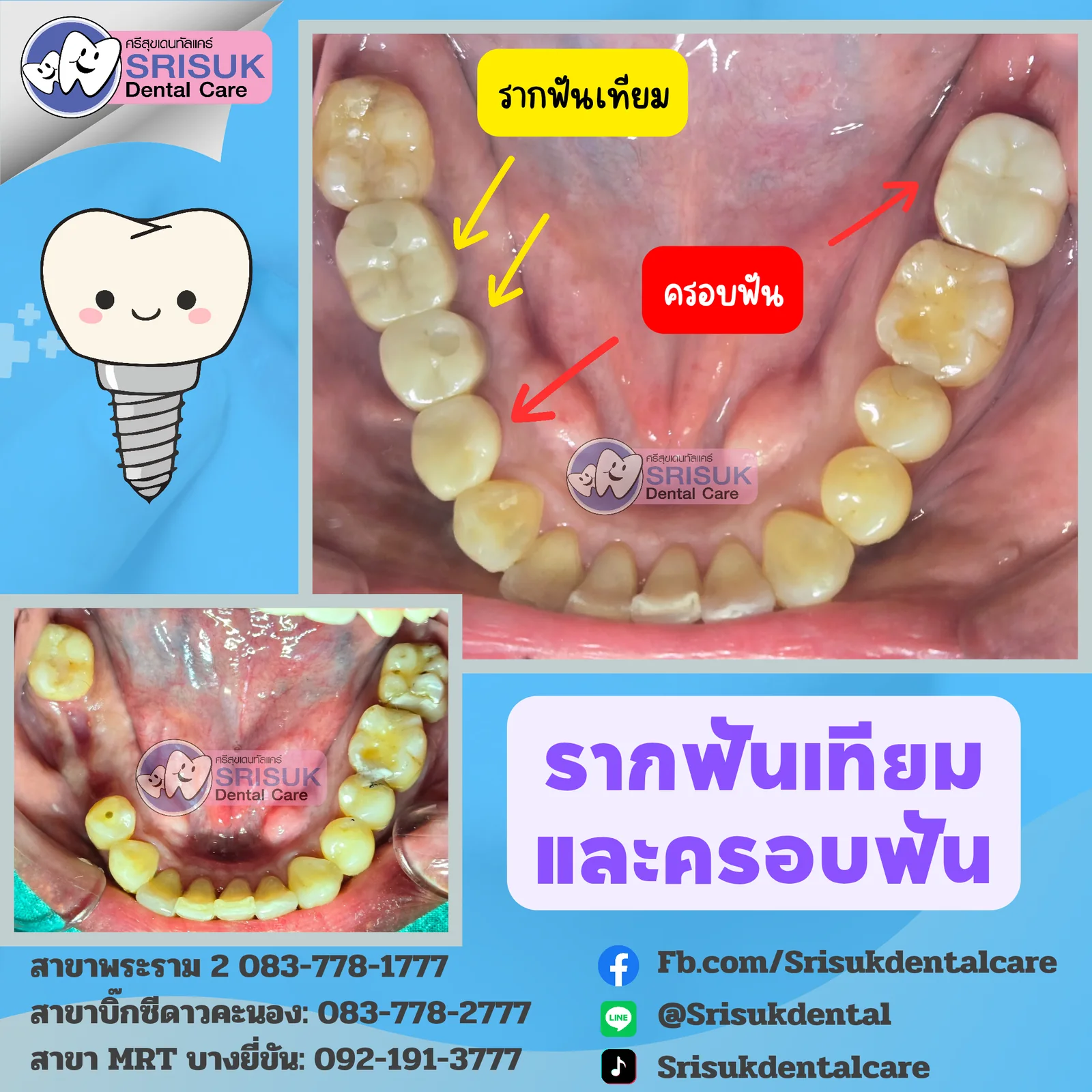 รายละเอียดรากเทียมฟันกราม