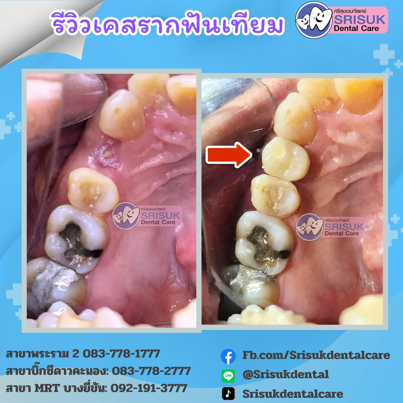ครอบฟันบนรากเทียมระยะใกล้