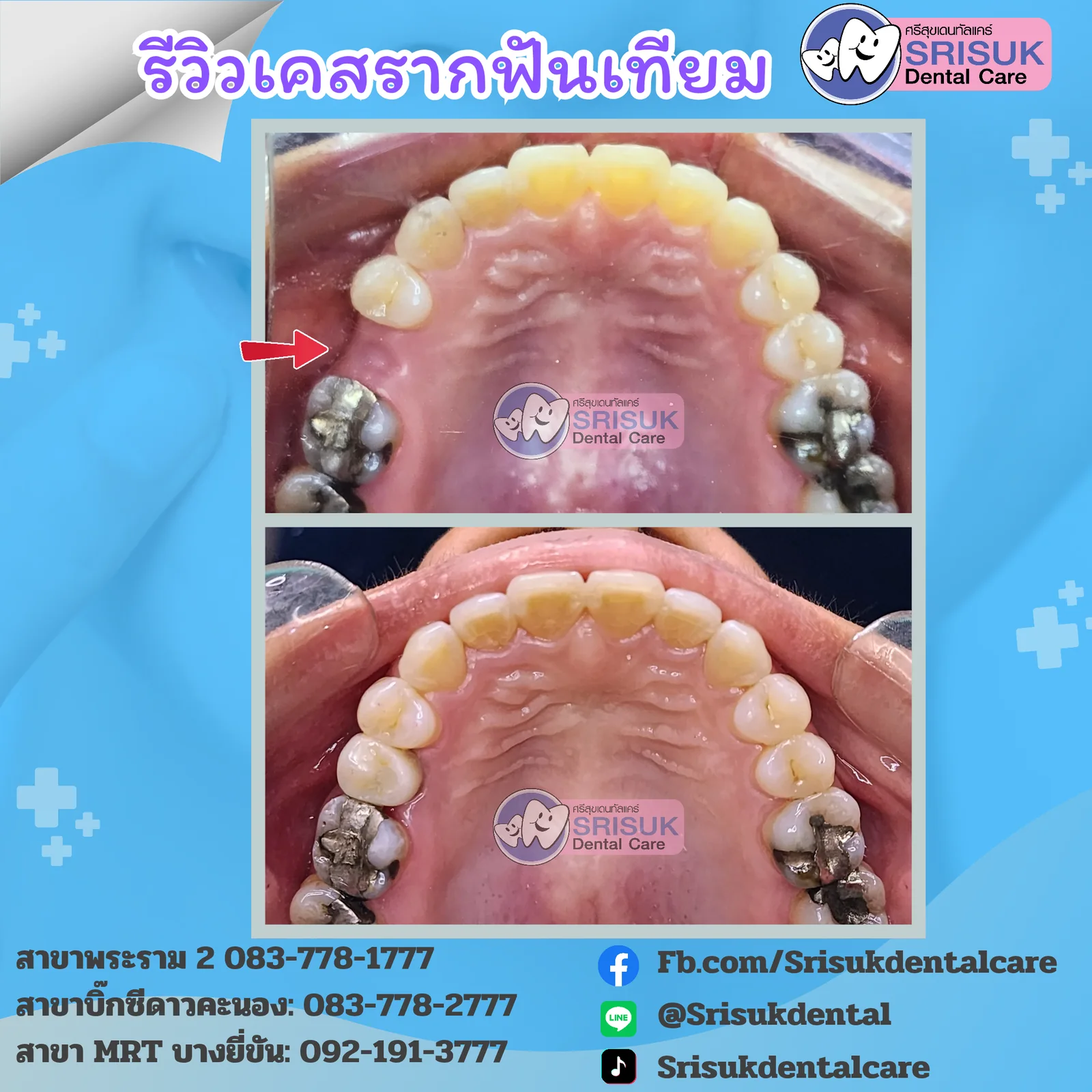 การบูรณะรากเทียมหลายตำแหน่ง