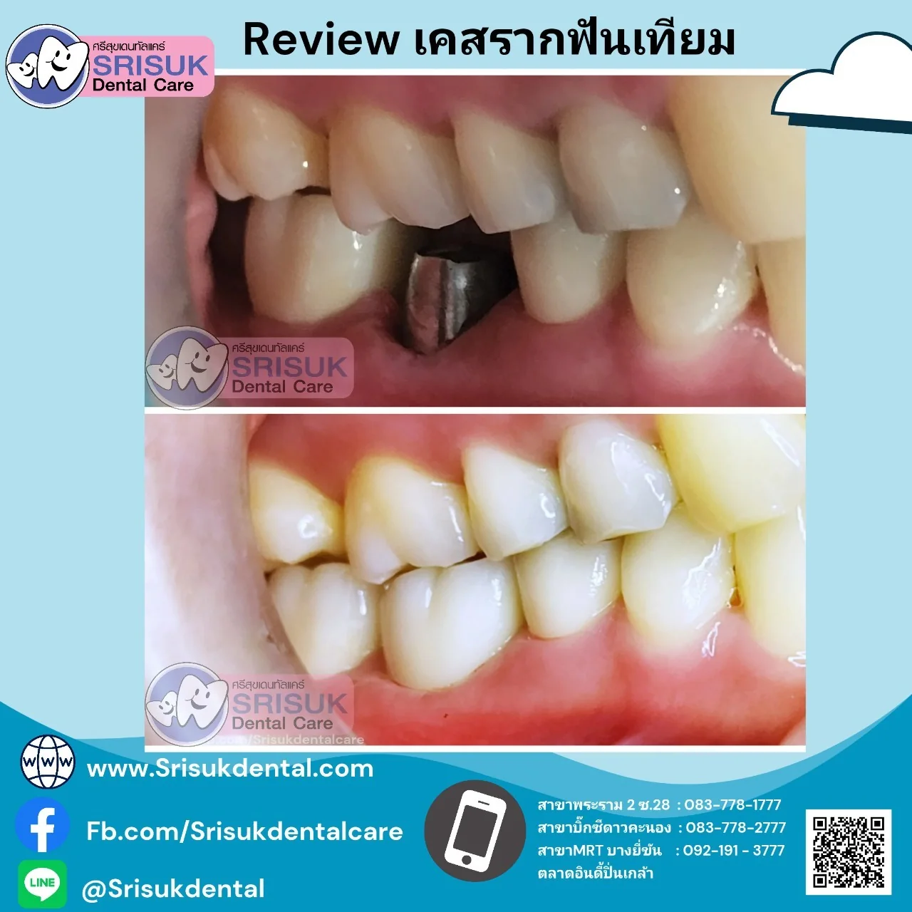 รากเทียมและครอบฟันบริเวณฟันหลัง