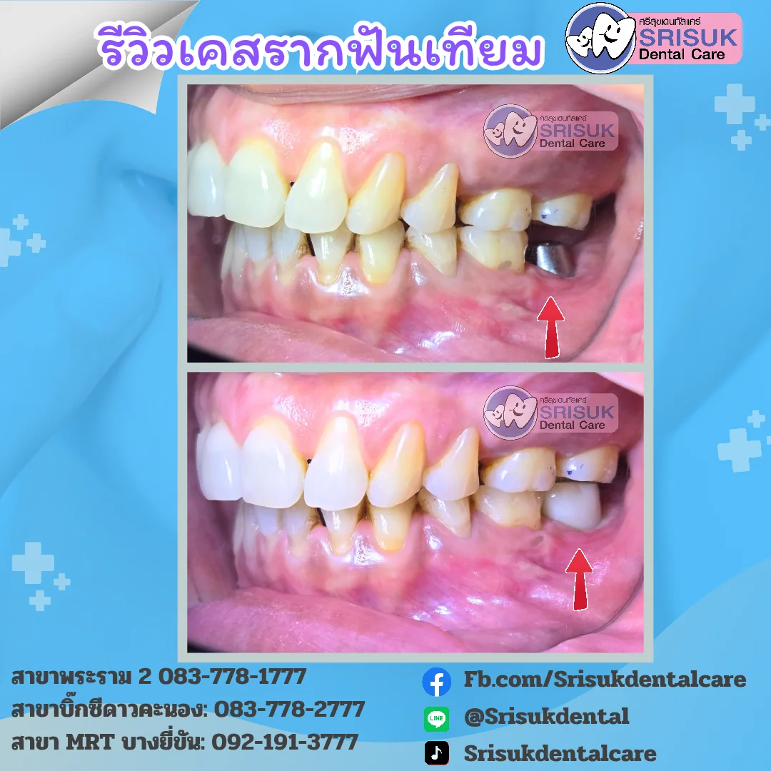 เติมช่องว่างฟันหลังด้วยรากเทียม