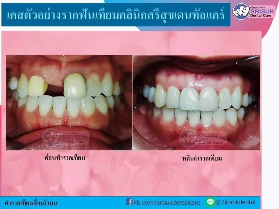 ผลลัพธ์เมื่อมองจากแนวรอยยิ้ม