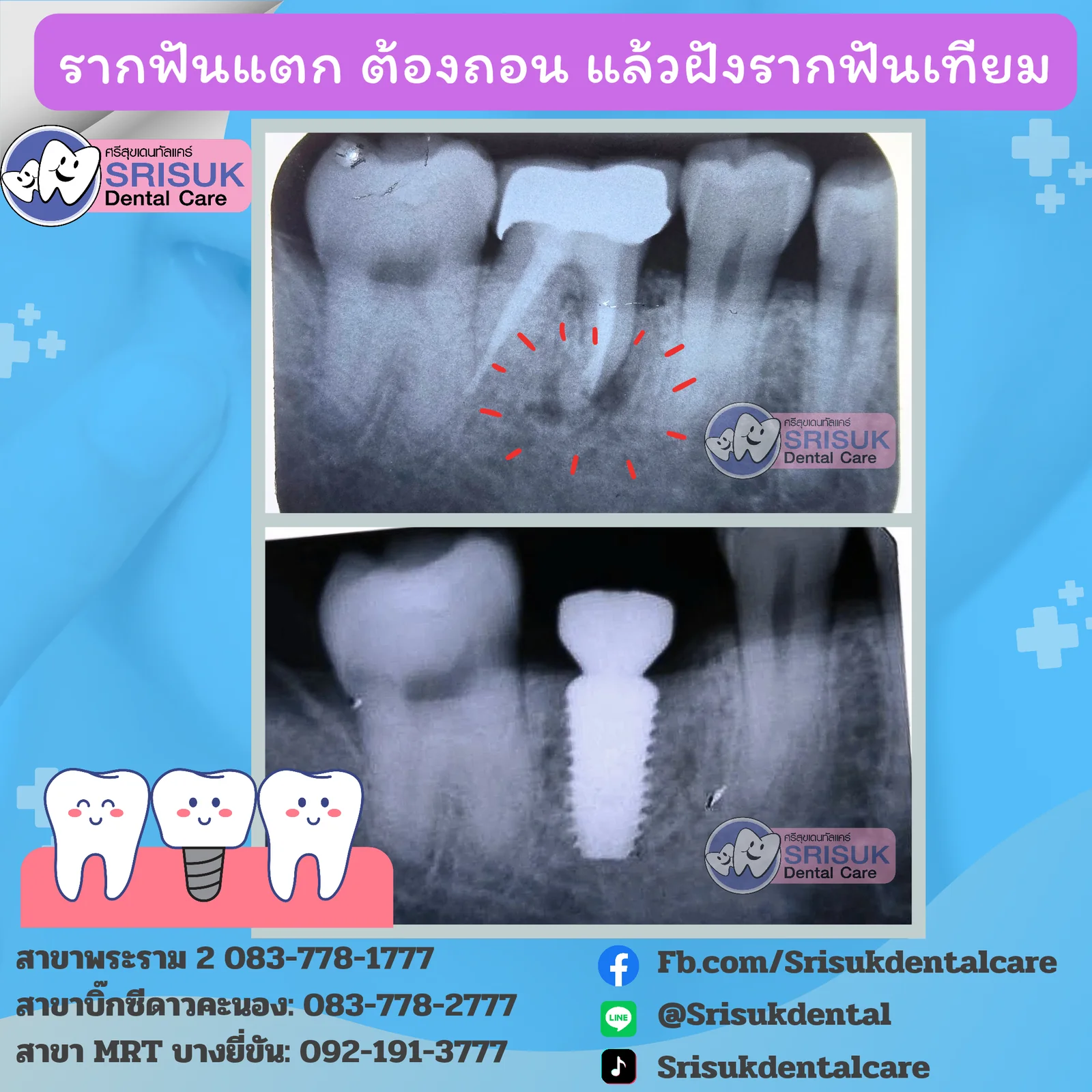 ตรวจสอบตำแหน่งรากเทียมด้วยเอกซเรย์