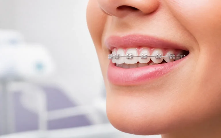 จัดฟันแบบดามอน (Damon Braces)