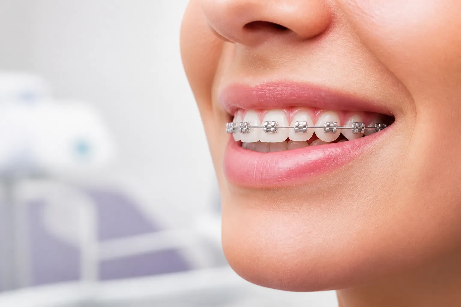 จัดฟันแบบดามอน (Damon Braces)