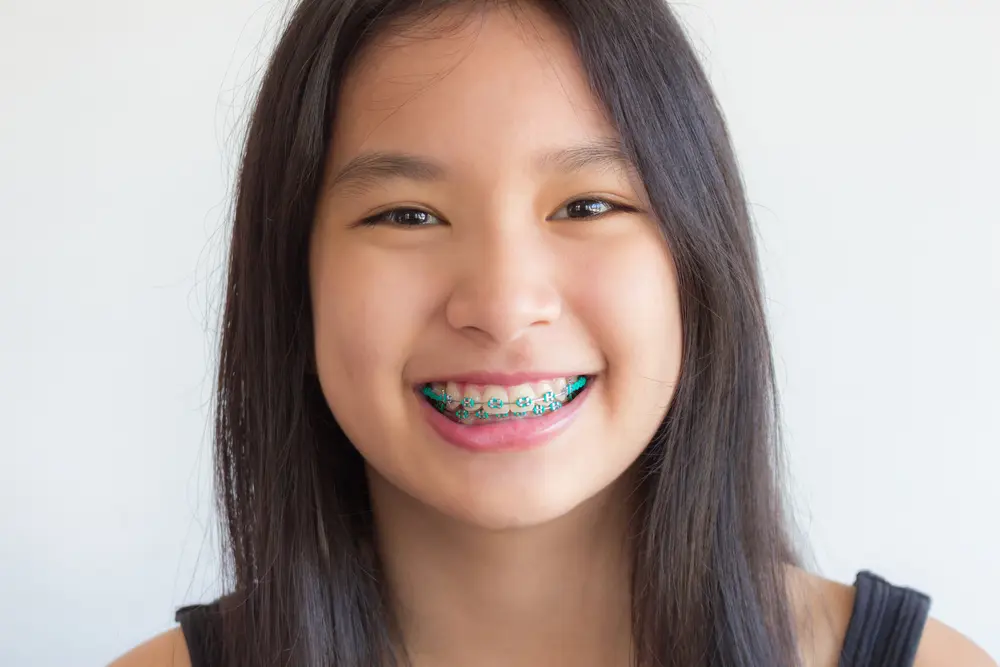 Clear Aligner
