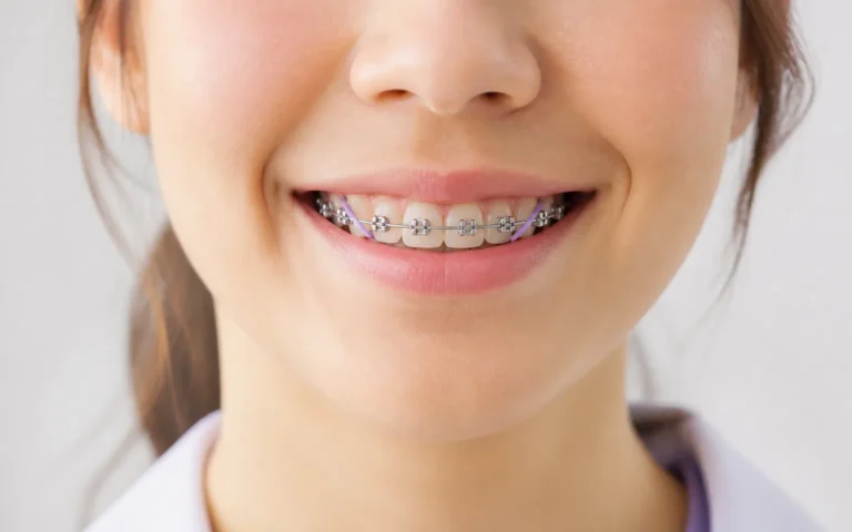 จัดฟันแบบติดแน่น (Metal Braces)