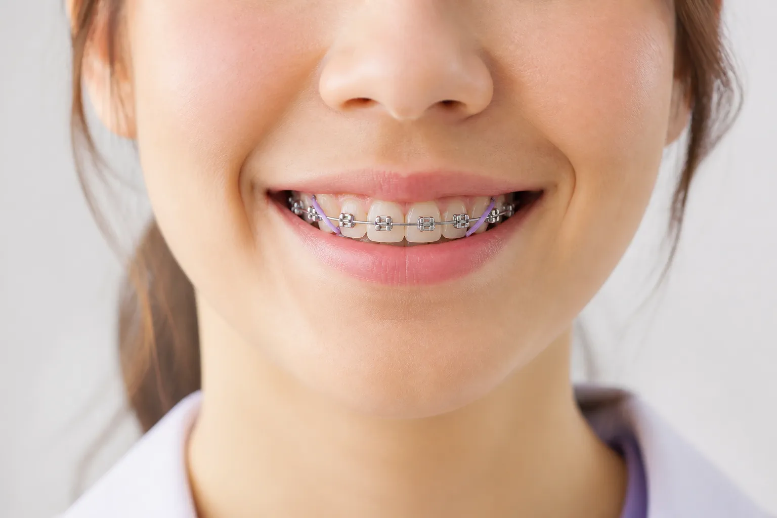 จัดฟันแบบติดแน่น (Metal Braces)